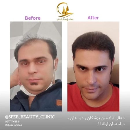 کاشت مو
