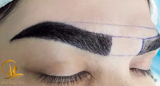 کاشت ابرو به روش FUT